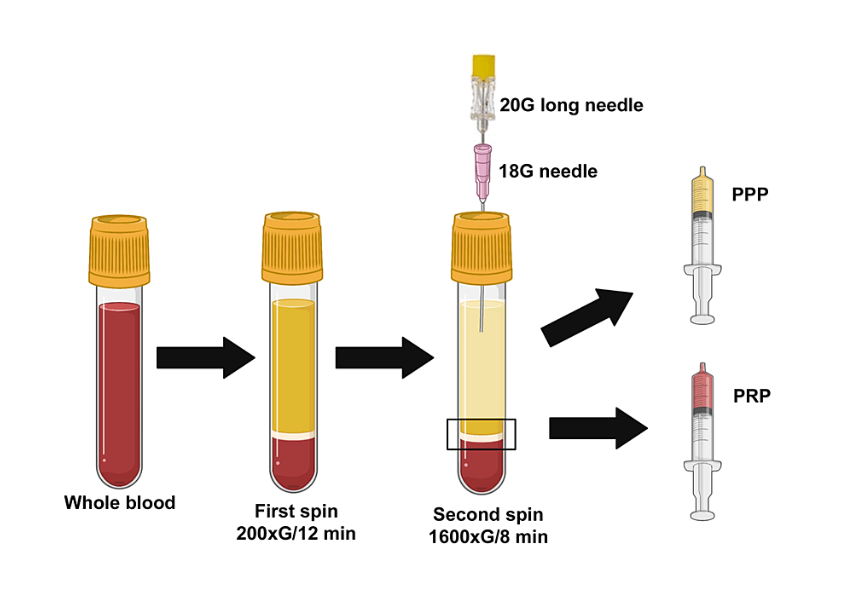 Platelet-rich plasma. layers of blood in glassware tube. Test tube